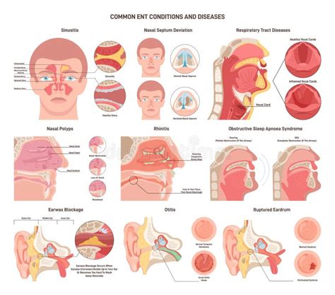 ent disease.